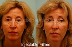 Fillers Before & After