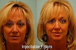 Fillers Before & After