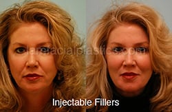 Fillers Before & After