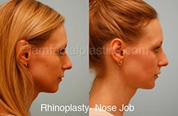 Fillers Before & After