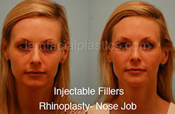Fillers Before & After