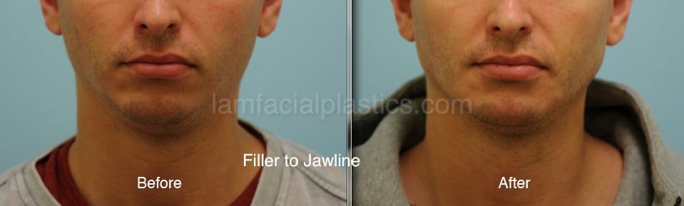 Fillers Before & After