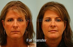 Fillers Before & After