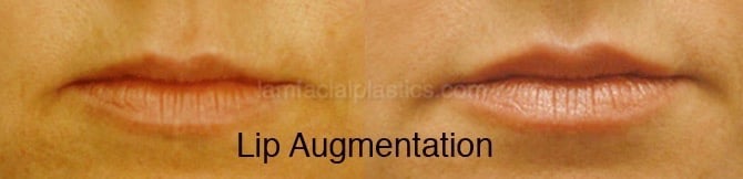 Fillers Before & After
