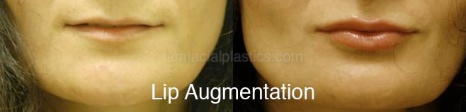 Fillers Before & After