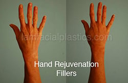 Fillers Before & After