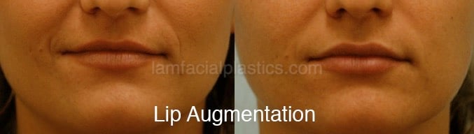Fillers Before & After