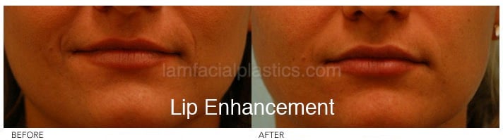 Fillers Before & After