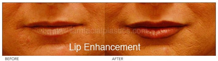 Fillers Before & After
