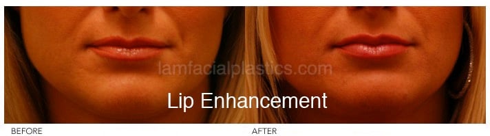 Fillers Before & After