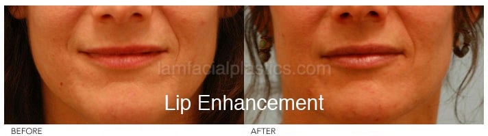 Fillers Before & After