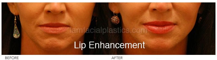 Fillers Before & After
