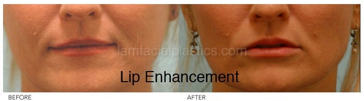 Fillers Before & After