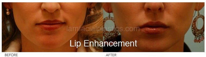 Fillers Before & After