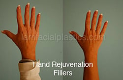 Filler Results