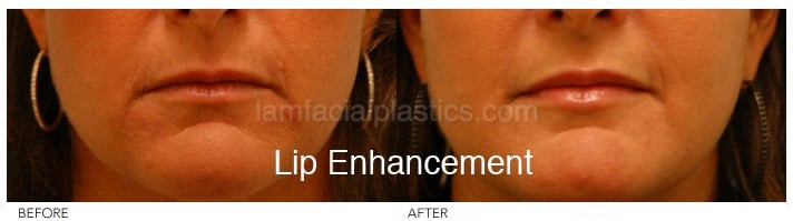 Fillers Before & After