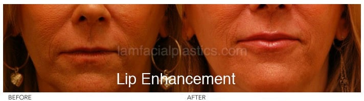 Fillers Before & After