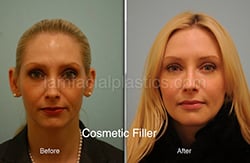 Fillers Before & After