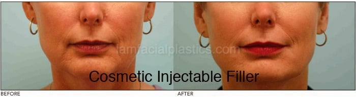 Fillers Before & After