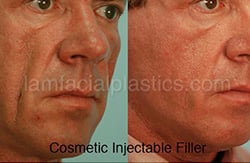 Fillers Before & After
