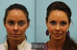 Fillers Before & After