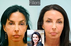 Fillers Before & After