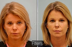 Fillers Before & After