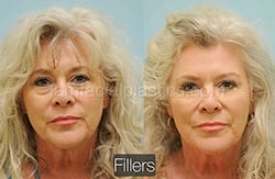 Fillers Before & After