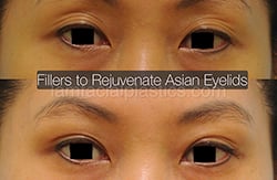 Fillers Before & After