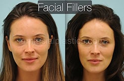 Fillers Before & After