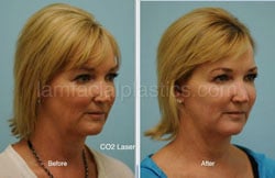 Laser Skin Resurfacing Before & After