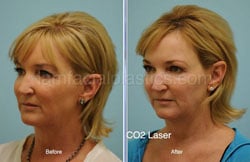 Laser Skin Resurfacing Before & After