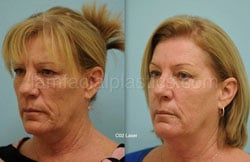 Laser Skin Resurfacing Before & After