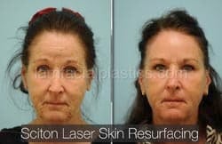 Laser Skin Resurfacing Before & After