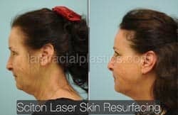 Laser Skin Resurfacing Before & After