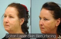 Laser Skin Resurfacing Before & After