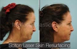 Laser Skin Resurfacing Before & After