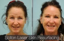 Laser Skin Resurfacing Before & After