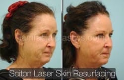 Laser Skin Resurfacing Before & After