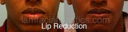 Lip Reduction Before & After