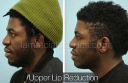 Lip Reduction Before & After