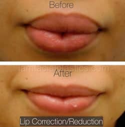 Lip Reduction Before & After