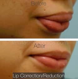 Lip Reduction Before & After