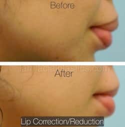 Lip Reduction Before & After