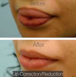 Lip Reduction Before & After