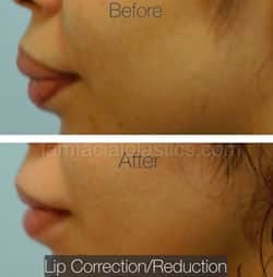 Lip Reduction Before & After