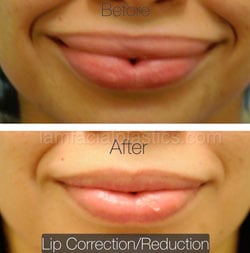 Lip Reduction Before & After