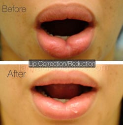 Lip Reduction Before & After