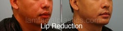 Lip Reduction Before & After
