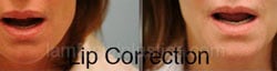 Lip Reduction Before & After